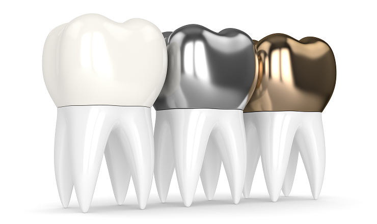 3d render teeth with different types dental crown 1